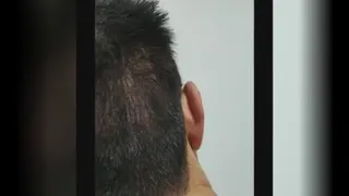 میکرواسکالپ