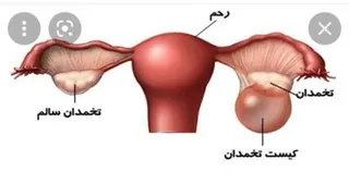 کیست تخمدان چیست؟