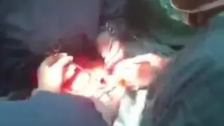 جراحی معده کودک 7 ماهه
