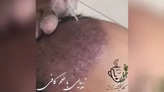 مزو تراپی مو