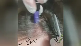 مزو تراپی