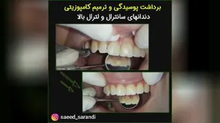 بهترین متخصص کامپوزیت بهترین دندانپزشک اصفهان