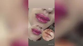 تزریق ژل مینا