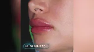 تزریق ژل لب