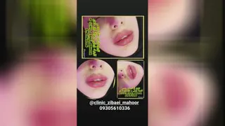تزریق ژل لب مدل روسی