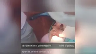 جراحی دندان عقل بدون بی حسی با هیپنوتیزم در دختر 25 ساله در قزوین