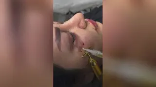 ژل و بوتاکس