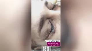 ژل و بوتاکس