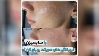 از بین بردن جای جوش(سابسیژن) خانم دکتر ابوطالبی