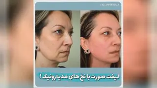لیفت صورت خانم دکتر ابوطالبی