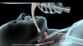آموزش روش اینتوبه کردن بیمار ( انتوباسیون Tracheal intubation )
