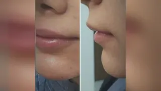 تزریق ژل لب،فرم دهی چانه،زاویه سازی