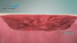تشخیص زخم عفونی