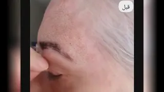 رفع افتادگی پلک در اصفهان