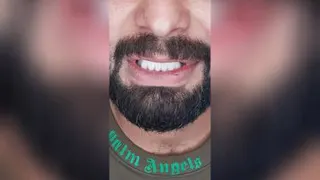 لمینت دندان در اصفهان