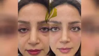 فیلر زیر چشم