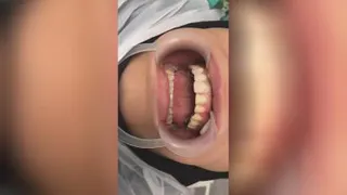 لامیننت سرامیکی با کمترین میزان تراش