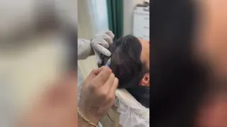 مزو تراپی مو