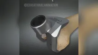 تعویض زانو و مفاصل
