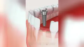 ایمپلنت های دندان جلو