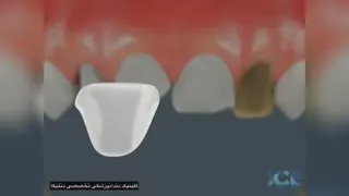 لمینیت و ونیر کامپوزیت