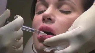 تزریق ژل به لب