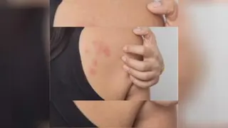 ویدیو داروی کبداک