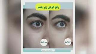 رفع گودی زیر چشم