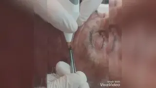 برداشتن منگوله پوستی