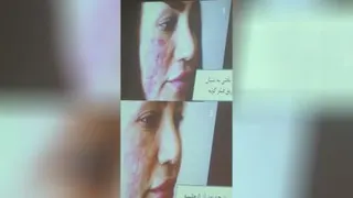 درمان زخم.دهمین کنگره بین المللی زخم و ترمیم بافت (باریتا)