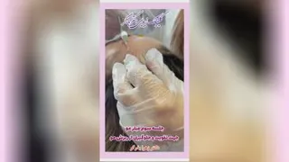 جلسه سوم فیلر مو