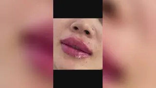 تزریق ژل لب کرج