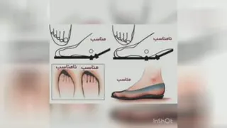 عارضه انگشت شست