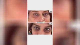 رفع گودی زیر چشم در گوهردشت کرج