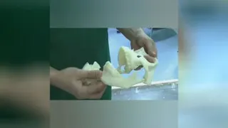 جراحی نادر و کم نظیر فک نوزاد 23 روزه