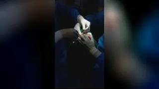 حذف چربی های پلکهای پف دار با روش جراحی بلفاروپلاستی