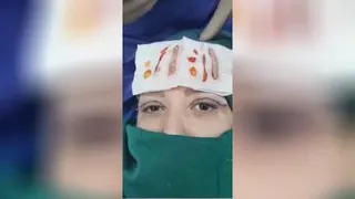 توضیحات دکتر در مورد بلفاروپلاستی و حذف محتویات اضافه پلک