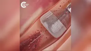 نحوه خارج کردن لخته خون ازرگ