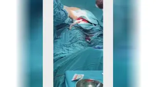 جراحی سزارین