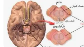 بیماری پارکینسون و توضیحاتی درباره ان