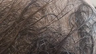 مزوتراپی مو بدون درد