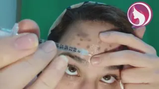 مزوتراپی_ پوست و مو دات آی آر