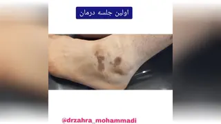 کربوکسی تراپی