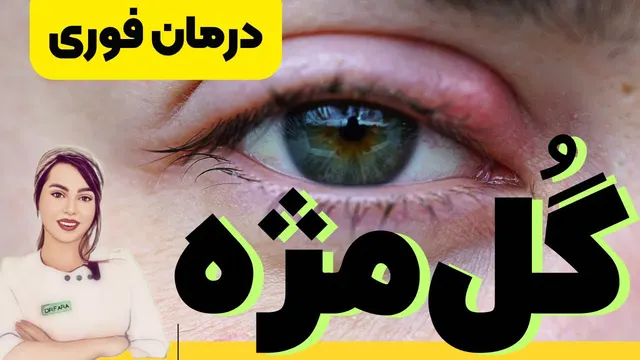 روش‌های سریع درمان گل‌مژه در خانه: کنترل عفونت و ورم پلک