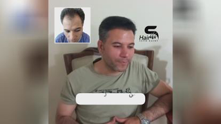 کاشت موی اقایان