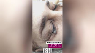 ژل و بوتاکس