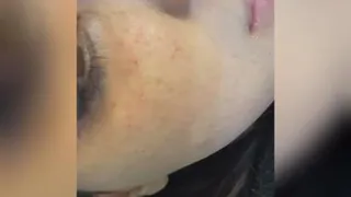 کربوکسی رفع تیرگی چشم