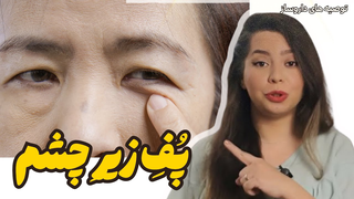 چرا زیر چشم‌ها پف می‌کند و چگونه درمانش کنیم؟ | بهترین کرم‌ها، مکمل‌ها و روتین‌های ضد پف