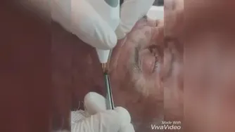 برداشتن منگوله پوستی