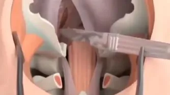 تصاویری از نحوه برداشتن تومور مغزی